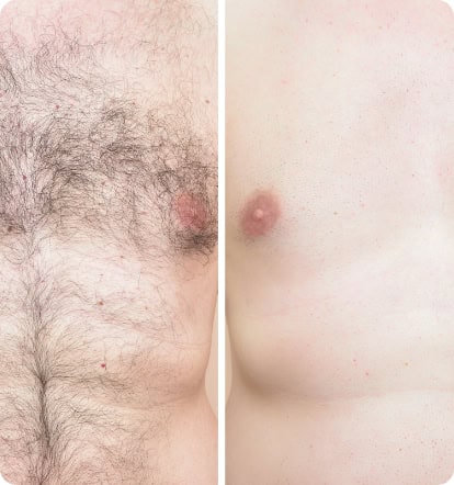 LG-LaserRemoval-BeforeAfter@2x