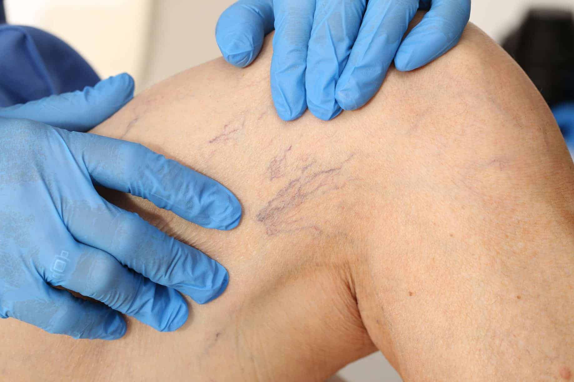 medical professional treating spider veins in boca raton