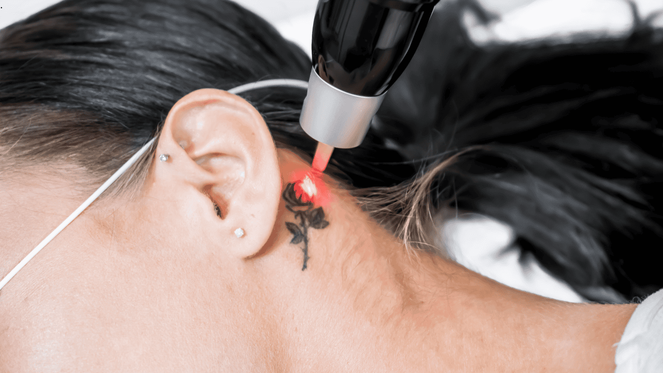 Lumenis Laser | Rf Microneedling | Lumenis Sale | Lumenis Treatments and Sale Options | Contact us Today